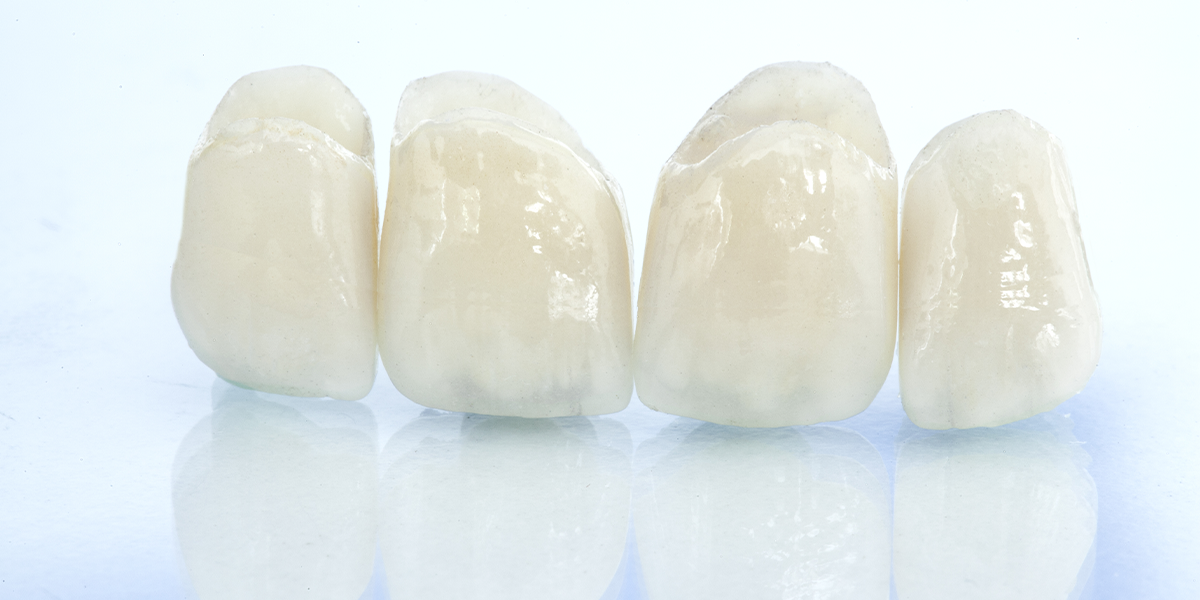 セラミック治療期間に仮歯が必要な理由とその役割
