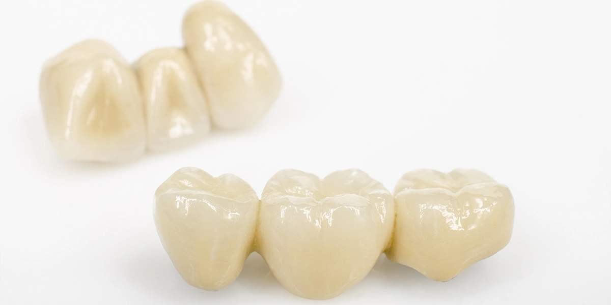 金属アレルギーの発症とセラミックの生体親和性が注目される理由