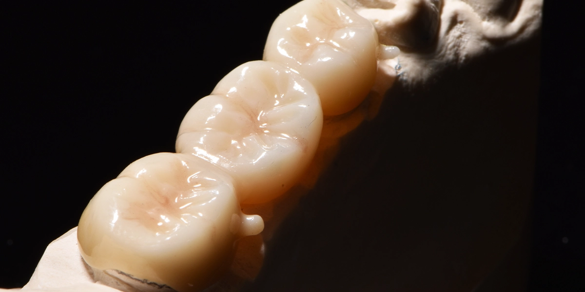 セラミック治療がもたらす生体親和性のメリットと素材の特徴