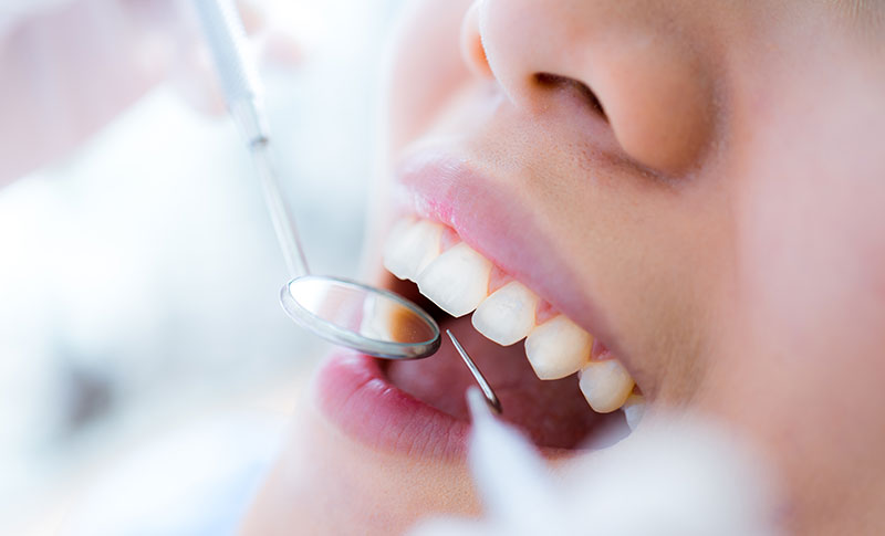 歯周基本治療
