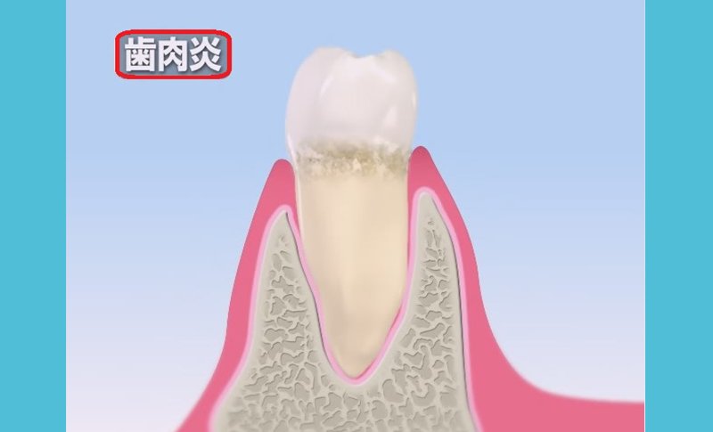予防歯科イメージ