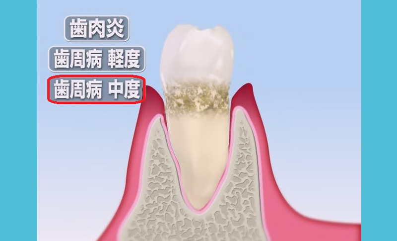 予防歯科イメージ