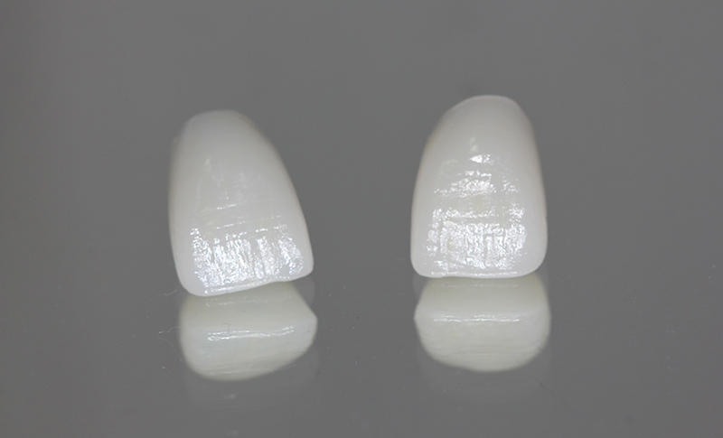 ガラスセラミック（e-max等）