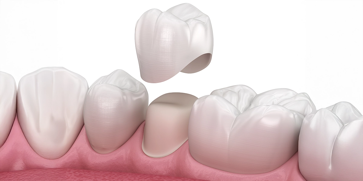 奥歯のセラミック治療の特徴