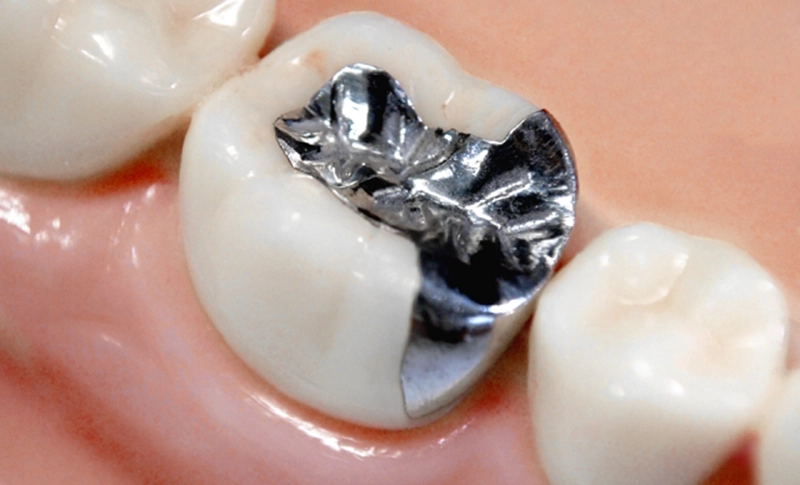銀歯との違い：虫歯の再発リスクが低い