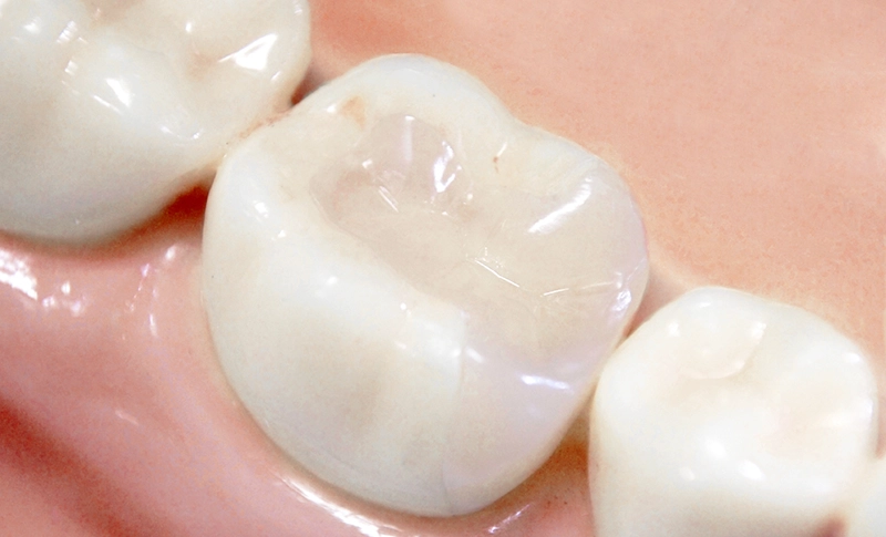 小さな虫歯から中程度の虫歯まで対応