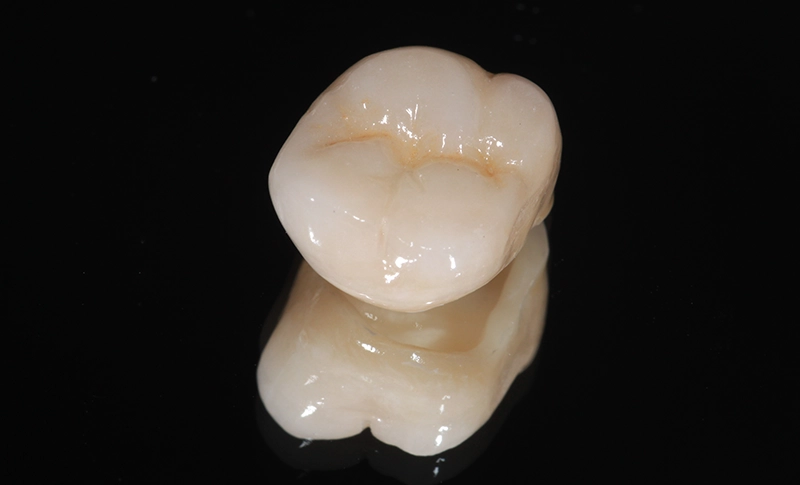 大きな虫歯や欠損に対する全体的な修復