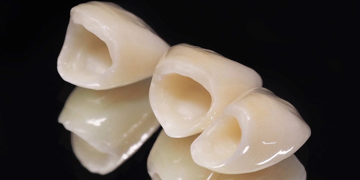 保険の差し歯が抱えるセラミックと比べたときの問題点