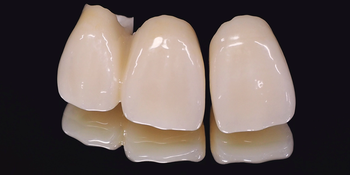 差し歯をセラミックに替える費用と素材の種類の選び方